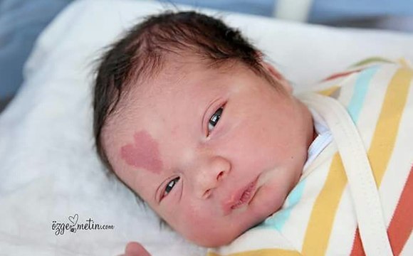Cet enfant est né avec une tâche de naissance en forme de cœur, voici à quoi il ressemble 5 ans plus tard