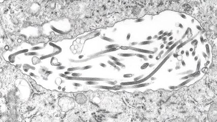 Médico infectado de ébola muestra mejoría