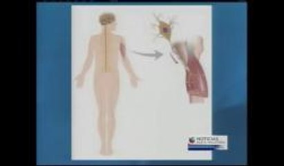 Esclerosis lateral amiotrófica (ALS)