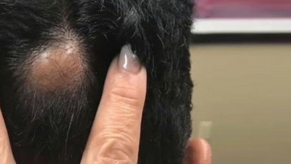 Adamın kafasındaki derinin altından çıkana, ameliyatı yapan doktor bile inanmadı