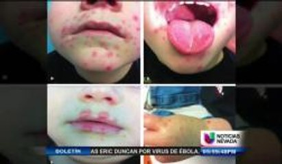 Reportan casos de enfermedad contagiosa en guarderías