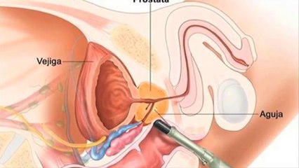 FL: Prevenir el cáncer de próstata