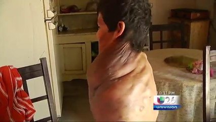 Extirpan  tumór a un  niño de Juárez en Albuquerque