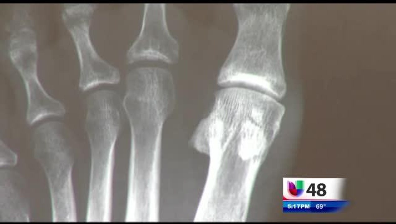 Fracturas Causadas Por El Estrés
