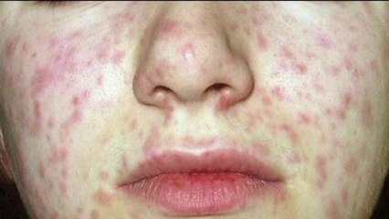 Contagios de sarampión y cómo prevenirlos