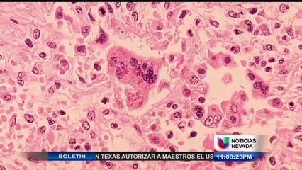 Los más adinerados podrían estar más en riesgo de contraer sarampión