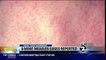 More Measles Cases Reported