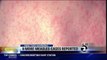 More Measles Cases Reported