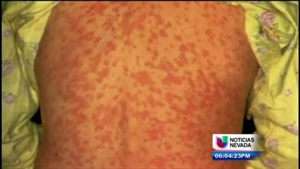 Elko Nevada investiga posible caso de sarampión