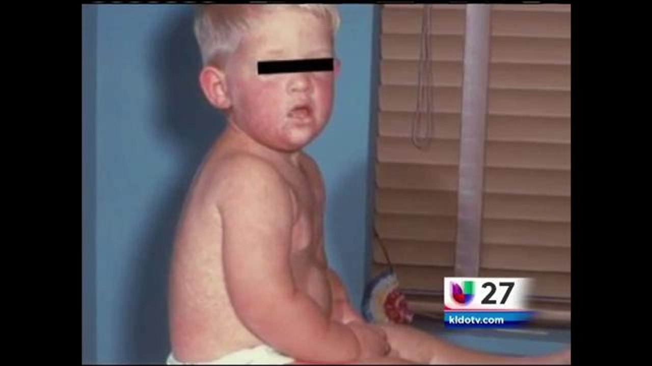 Pregunte Por Su Salud:Casos de Sarampión Confrimados