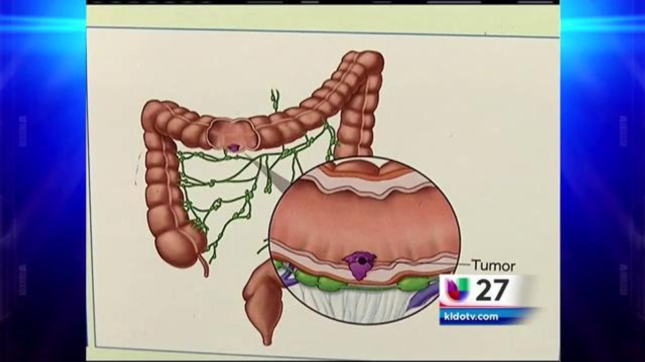 Cáncer de Colon