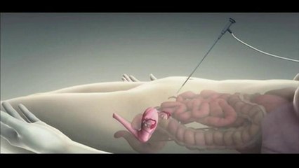 En Salud: Estirpación de los ovarios