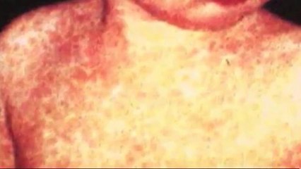 Alerta de Salud: Caso de Sarampión en Osceola