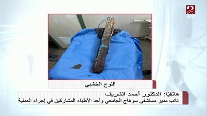 فريق طبي بمستشفى سوهاج الجامعي ينجح في استخراج لوح خشبي من جسد شاب