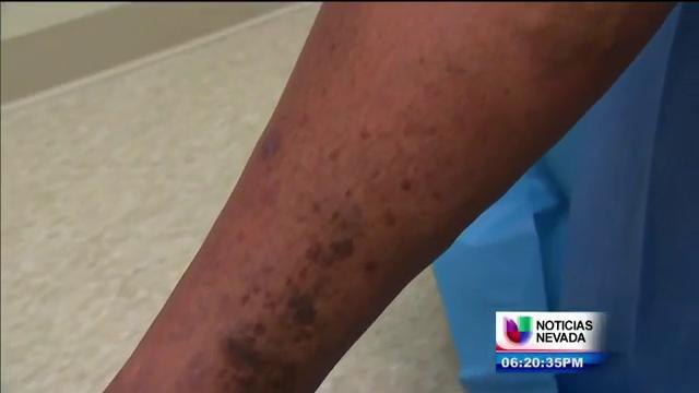 Venas varicosas pueden afectar a todos