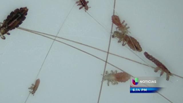 ¿Cómo prevenir los piojos en los niños?