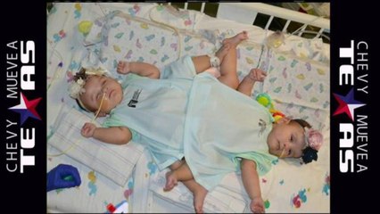 Fueron separadas con exito las siamesas Ximena y Scarlet