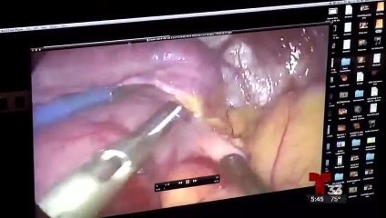 Hasta 300 cirugías bariátricas se practican mensualmente en Tijuana