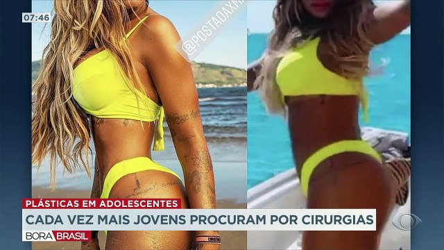 Cada vez mais jovens estão recorrendo as cirurgias plásticas para alcançar a imagem perfeita. Os filtros das redes sociais estão sendo exemplo nessa busca.