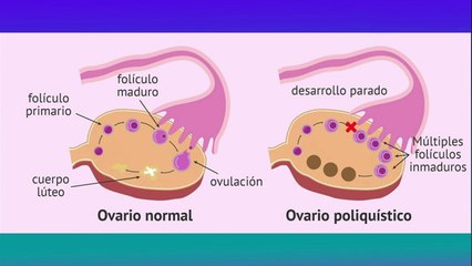 Video herunterladen: bd-sindrome-de-ovario-poliquistico-181121