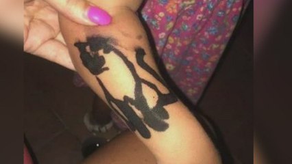 Three-year-old scarred for life after getting a henna tattoo