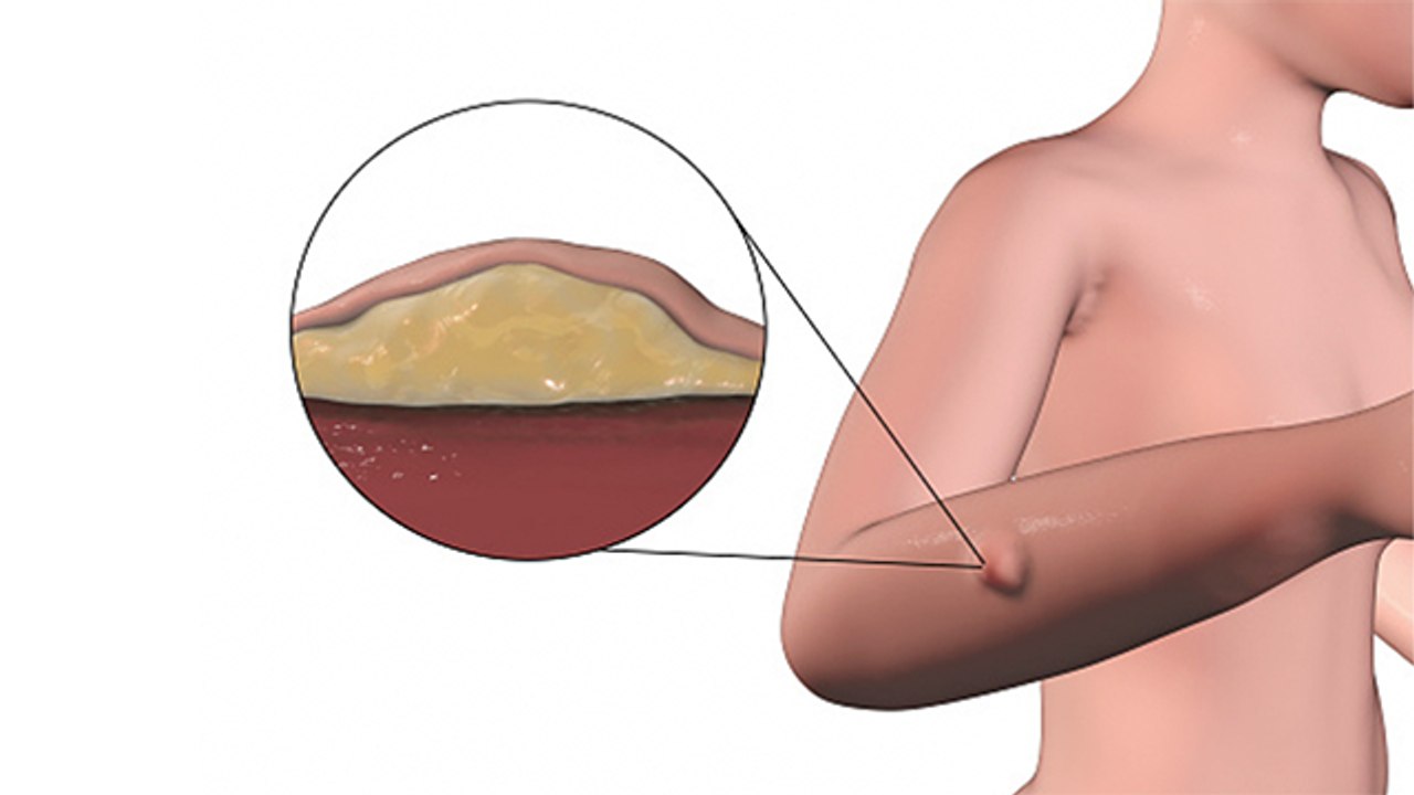 हर गांठ कैंसर होती है क्या, DOCTORS ADVICE | Ganth Cancer Ke Lakshan | Boldsky