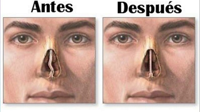 bd-complicaciones-de-tabique-nasal-desviado-251121