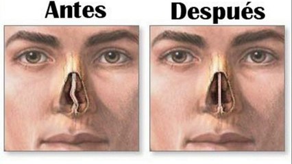 bd-complicaciones-de-tabique-nasal-desviado-251121
