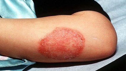 दाद, खाज और खुजली को जड़ से सफाया करेगा ये उपाय, बस अपनाए ये तरीका । Boldsky