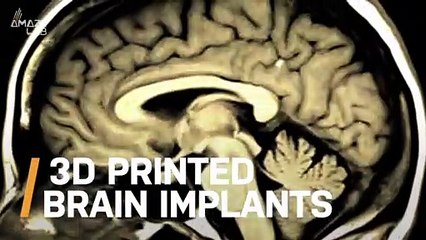 Check Out These 3D Printed Brain Implants of the Future