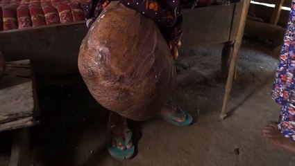 My 10KG Tumour Won’t Stop Growing | BORN DIFFERENT