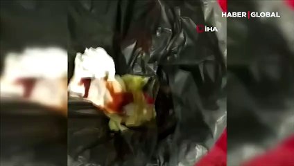 Nevşehir'de özel bir hastanede doğum yapan kadının vücudunda sargı bezi unutulduğu iddia edildi