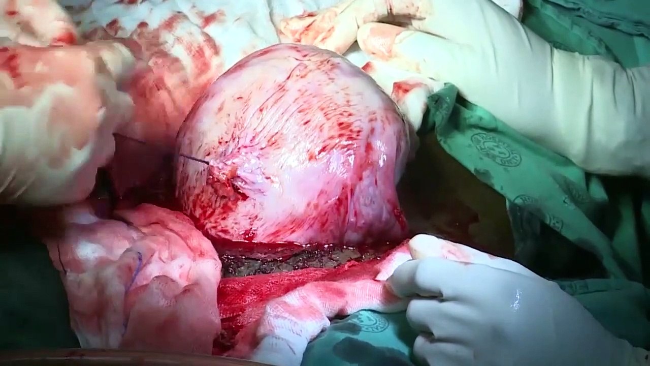 Difficult Caesarean Sections
