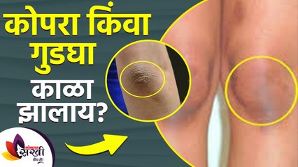 हाताचा कोपरा आणि गुडघ्याच्या त्वचेची कशी घ्याल काळजी | How to get rid of dark elbows and knees |