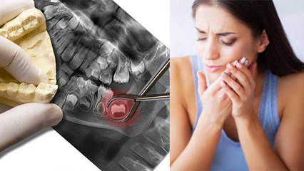 अकल दाढ़ निकलवाना चाहिए कि नहीं, Wisdom Teeth Nikalne Se Kya Hota Hai | Boldsky