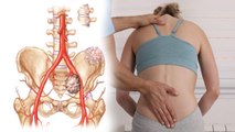 Spinal Tumor के Symptoms पहचानना जरूरी, मामूली पीठ दर्द से कमर दर्द है जानलेवा | Boldsky