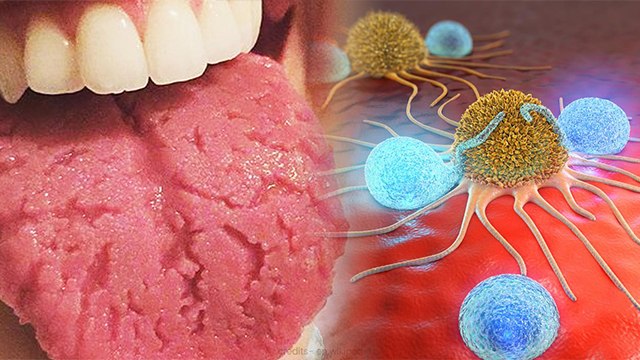 जीभ के कैंसर के ऐसे गंभीर लक्षण । जानें कारण, बचाव के उपाय और इलाज
