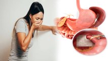पेट भरा भरा लगना Hiatal Hernia के Symptoms, कैसे करें बचाव | Boldsky