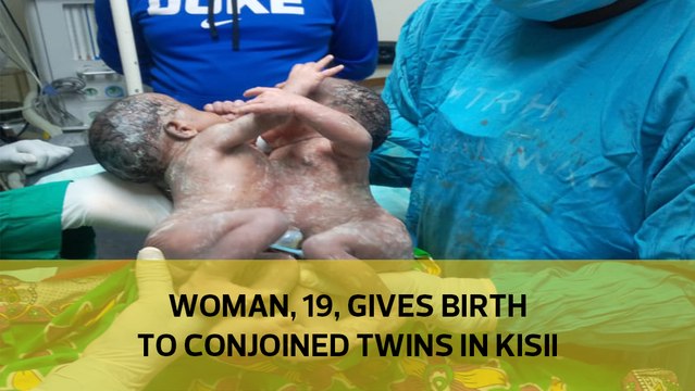 Woman, 19, gives birth to conjoined twins in Kisii