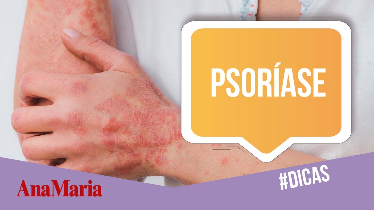 PSORÍASE: COMO IDENTIFICAR, QUAIS OS SINTOMAS E TRATAMENTO? (2021)