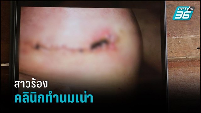 สาวร้องคลินิกทำนมเน่าพบเป็นหมอทำคลอด - เข้มข่าวค่ำ