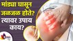 मांड्या घासून जळजळ होते? | How to Get Rid of Itchy Thighs | Home remedies for itchy thighs #Skincare