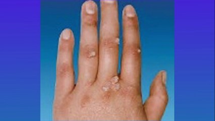 bd-verrugas-mezquinos-y-cabezas-de-vena-causas-y-tratamientos-081221