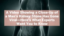A Video Showing a Close-Up of a Man's Kidney Stone Has Gone Viral—Here's What Experts Want You to Know