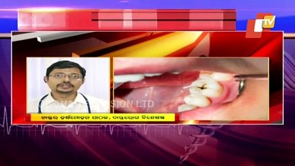 What Is Tooth Decay, Its Causes, Prevention And Treatment