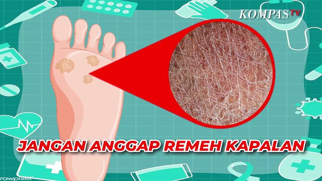Wajib Tahu! Penyebab Kapalan di Kulit, Salah Satunya Terlalu Sering Memakai Sepatu Hak Tinggi