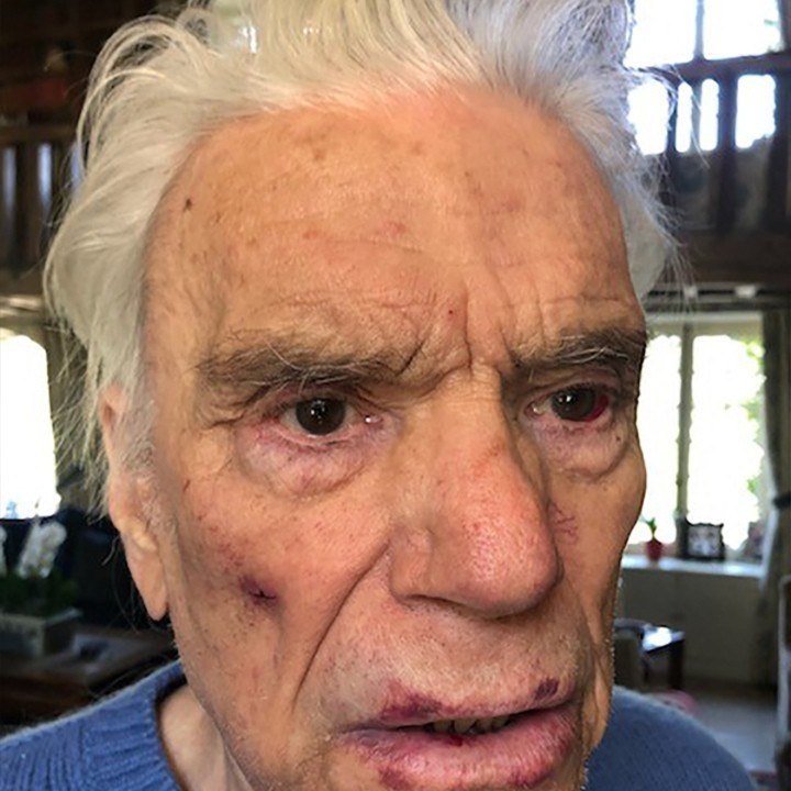 VOICI SOCIAL - Bernard Tapie cambriolé et battu : ce geste fou qu'il a réussi à faire face à ses agresseurs