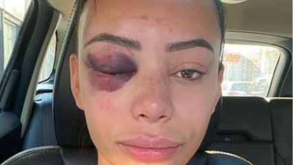 VOICI-PHOTOS Yasmine (Les princes et princesses de l'amour) : agressée et défigurée, son témoignage glaçant