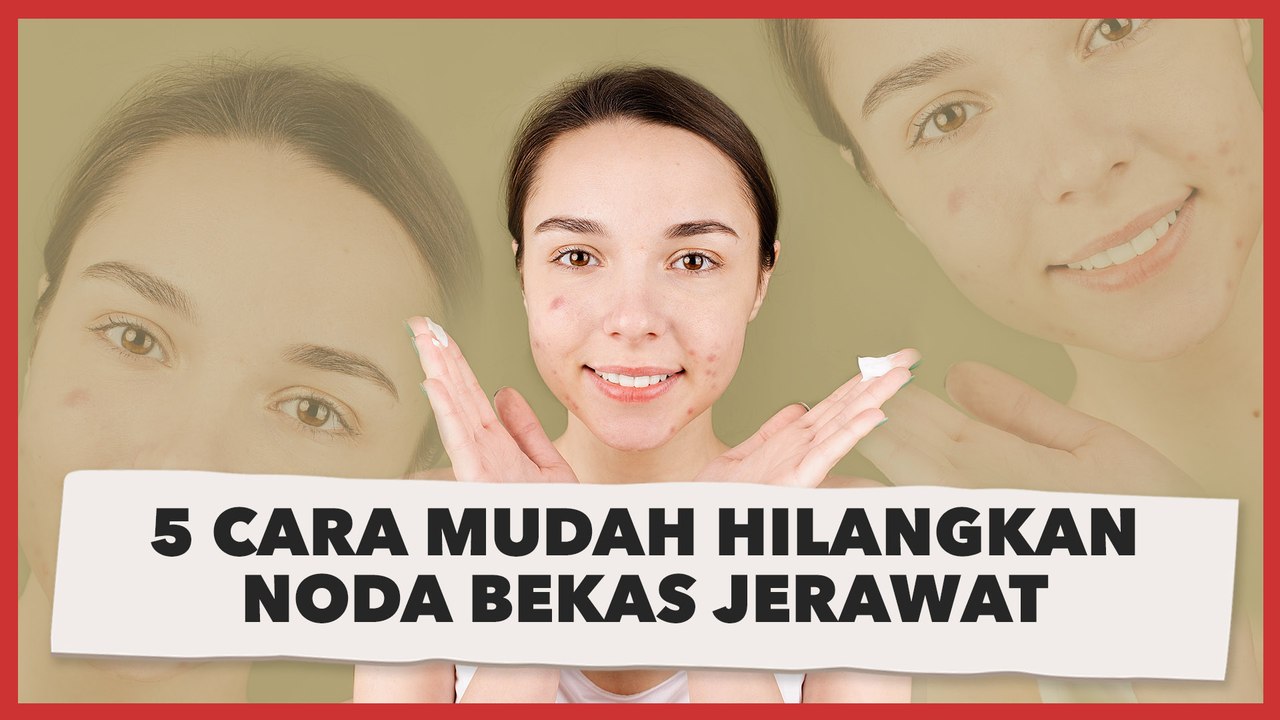 5 Cara Mudah Hilangkan Noda Bekas Jerawat, Tak Melulu Harus Mahal