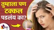 टक्कल पडलेल्या जागेवर काय करावं | How to Get Rid of Bald Spots | Baldness Cure | Baldness Treatment